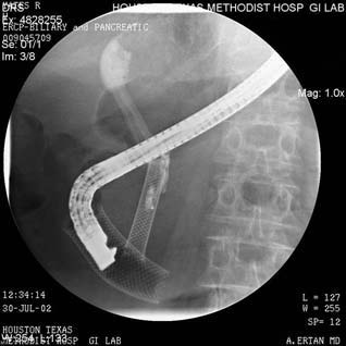 What is the use of a stent in an ERCP procedure?