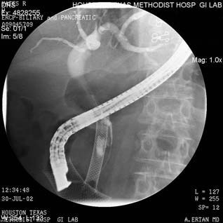 What is the use of a stent in an ERCP procedure?