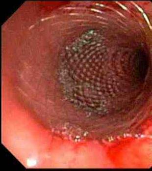 esophagus esophageal stent barrett stricture